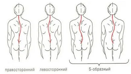 Csak egy újabb gyakorlat segít, hogy megszüntesse scoliosis