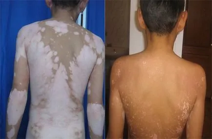 Tratamentul Vitiligo simptome foto care aceasta boala, cauzele