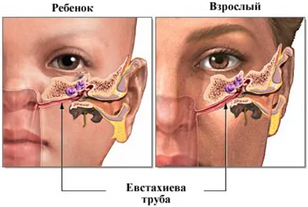 възпаление на ушите в детските симптоми и лечение на възпаление на средното ухо