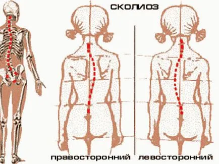 Просто още упражнение помага за премахване на сколиоза