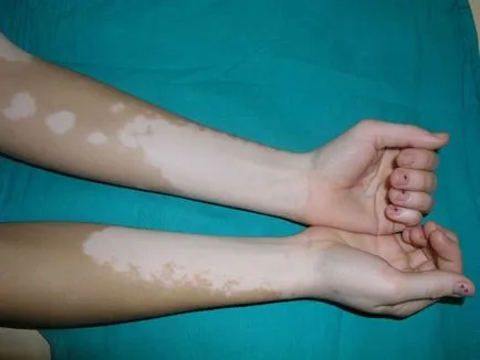 Vitiligo kezelésében fotó tünetek, hogy ez a betegség okai