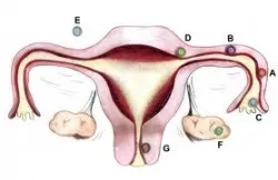 simptome ale sarcinii ovariene, semne sarcinii ovariene de maternitate