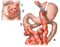 chirurgie de bypass gastric - Info Sanatate