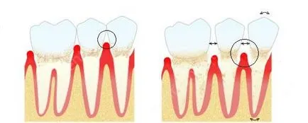 Ceea ce este comun intre parodontita si boli parodontale, ceea ce simptome și tratament