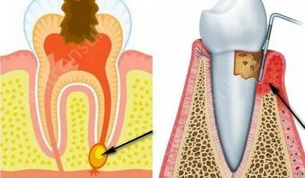 Mi a közös között periodontitis és a fogágybetegség, milyen tünetei és kezelése