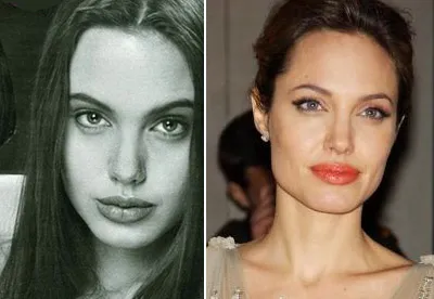 Andzhelina Dzholi пластична хирургия преди и след снимки, експерти коментари