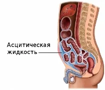 Ascites - tünetei és kezelése ascites