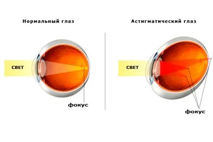 Astigmatismul la copii