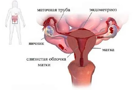 Възпалено долната част на корема и освобождаване, когато това се случва