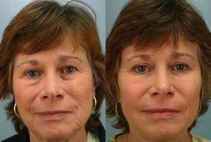 Blepharoplasty Szemhéj leírás, videó, fotók előtt és után