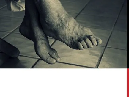Diseases of the Foot