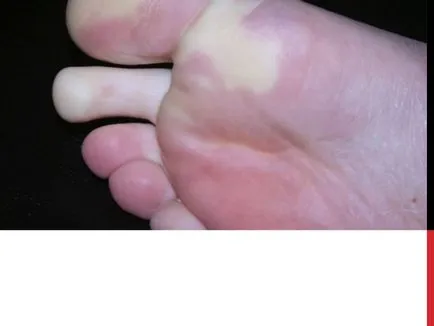 Diseases of the Foot