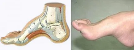 Foot deformitás megelőzésére és kezelésére - 3. oldal - Egészség konfiguráció