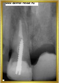 Dental-revü, fotók, klinikai eset №14 szakaszban implantáció és azonnali, átmeneti