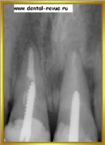 Dental-revü, fotók, klinikai eset №14 szakaszban implantáció és azonnali, átmeneti