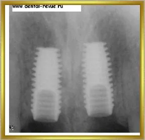 Dental-revü, fotók, klinikai eset №14 szakaszban implantáció és azonnali, átmeneti