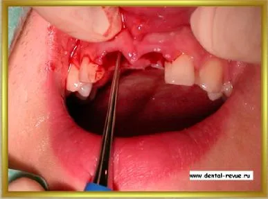 Dental-revü, fotók, klinikai eset №14 szakaszban implantáció és azonnali, átmeneti