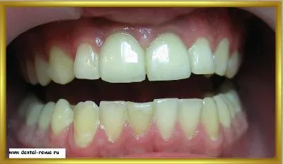 Dental-ревю, снимки, клиничен случай №14 етап имплантация и незабавна временна