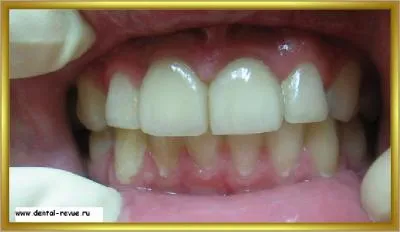 Dental-ревю, снимки, клиничен случай №14 етап имплантация и незабавна временна