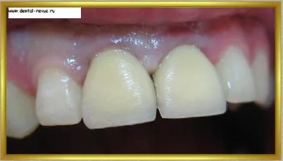 Dental-ревю, снимки, клиничен случай №14 етап имплантация и незабавна временна