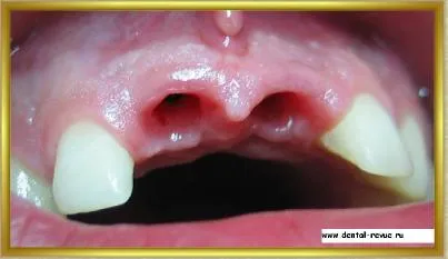 Dental-revü, fotók, klinikai eset №14 szakaszban implantáció és azonnali, átmeneti