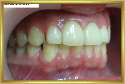 Dental-ревю, снимки, клиничен случай №14 етап имплантация и незабавна временна