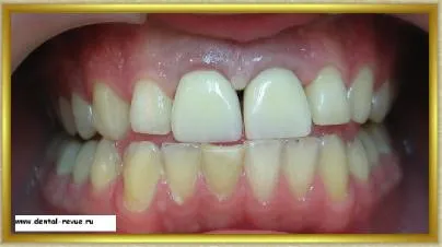 Dental-ревю, снимки, клиничен случай №14 етап имплантация и незабавна временна