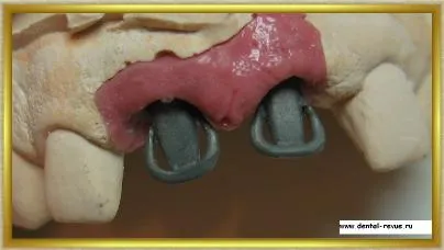 Dental-revü, fotók, klinikai eset №14 szakaszban implantáció és azonnali, átmeneti