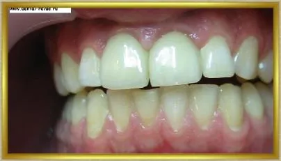 Dental-ревю, снимки, клиничен случай №14 етап имплантация и незабавна временна