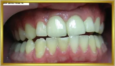 Dental-ревю, снимки, клиничен случай №14 етап имплантация и незабавна временна