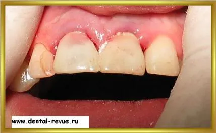 Dental-revü, fotók, klinikai eset №14 szakaszban implantáció és azonnali, átmeneti