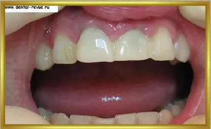Dental-revü, fotók, klinikai eset №14 szakaszban implantáció és azonnali, átmeneti
