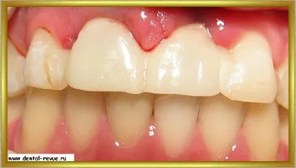 Dental-ревю, снимки, клиничен случай №14 етап имплантация и незабавна временна