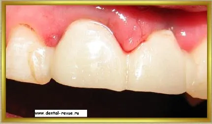 Dental-revü, fotók, klinikai eset №14 szakaszban implantáció és azonnali, átmeneti