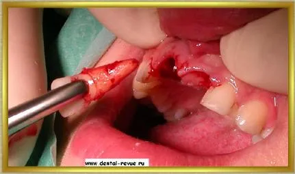 Dental-revü, fotók, klinikai eset №14 szakaszban implantáció és azonnali, átmeneti