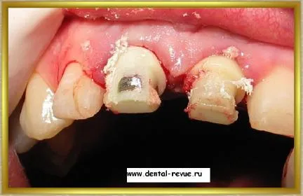 Dental-revü, fotók, klinikai eset №14 szakaszban implantáció és azonnali, átmeneti