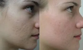 Co2 Дробни Laser третира белези, бръчки, изгаряния и популярен в козметологията