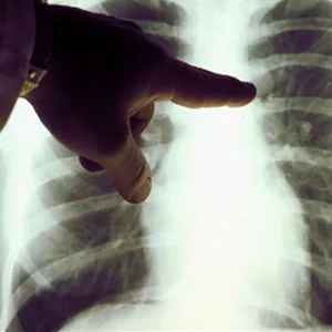 Diffúz emphysema prognózisa az élet, okok, tünetek, kezelés