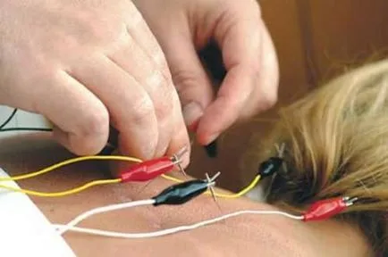 Electroacupunctura - ceea ce este această procedură și atunci când se aplică
