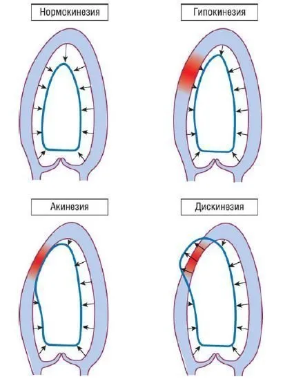 Ecocardiografia funcția sistolică ventriculară stângă