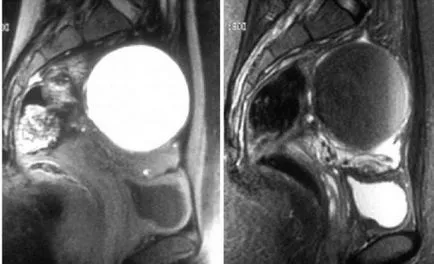 chist ovarian endometrioid ce este