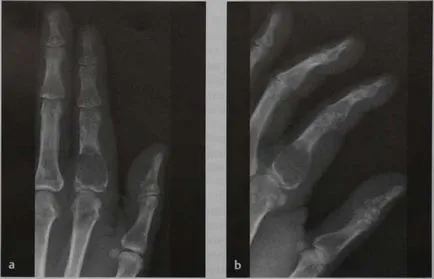 Enhondroma - egy jóindulatú intraossealis tumor