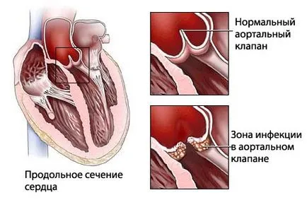 Endocarditis kép - kezelés a szív