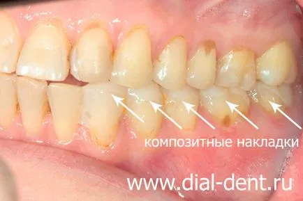 Restaurare estetică de coroane dentare ceramice