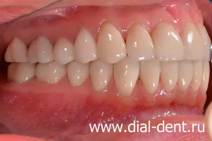 Restaurare estetică de coroane dentare ceramice