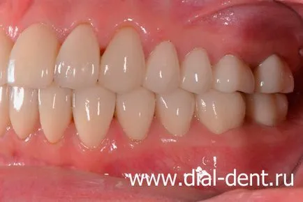 Restaurare estetică de coroane dentare ceramice