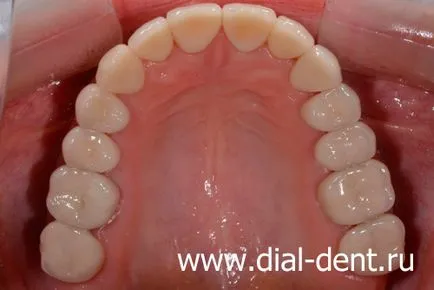 Restaurare estetică de coroane dentare ceramice