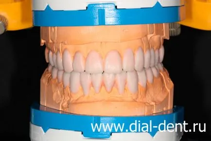 Естетична възстановяване на керамични зъбни коронки
