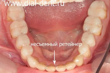 Restaurare estetică de coroane dentare ceramice