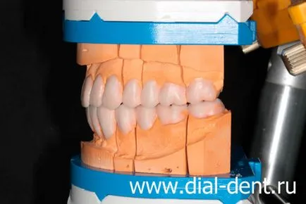 Restaurare estetică de coroane dentare ceramice